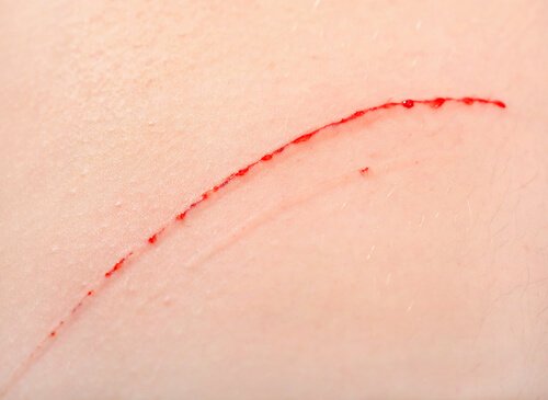 kattekradssyge kan osptå, når man er blevet kradset af en kat